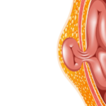 hérnia que não dói