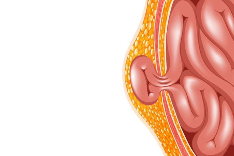 hérnia que não dói