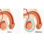 hidrocele